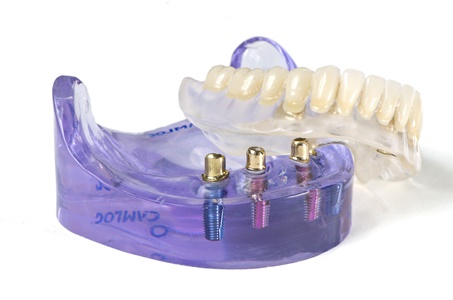 Denture-Stabilization-2-1